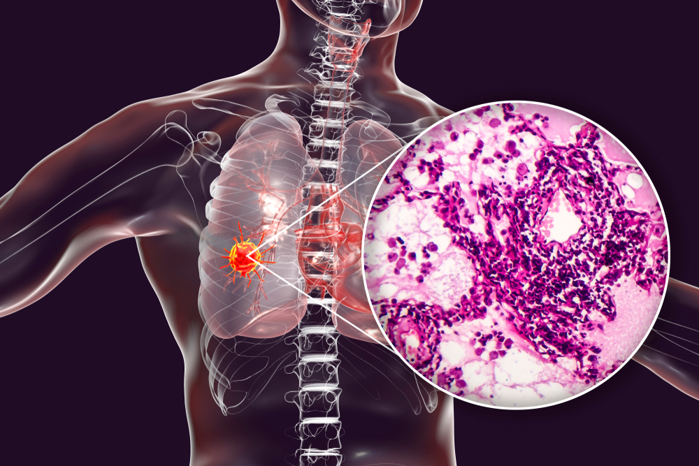 Adenocarcinoma