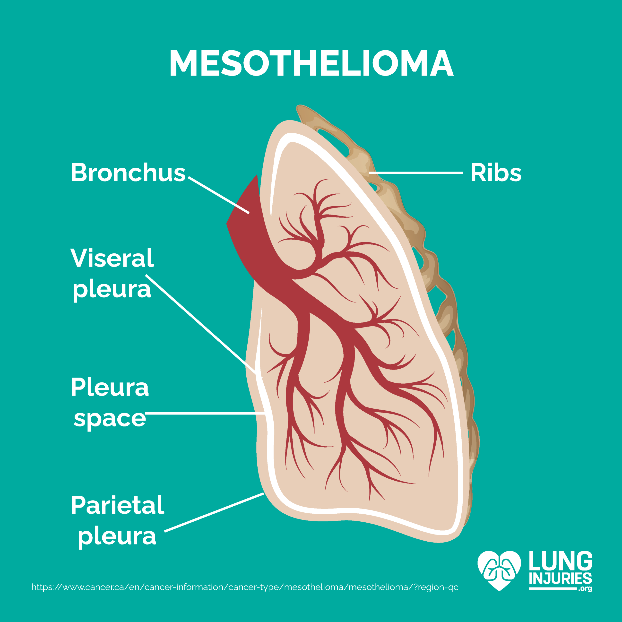 mesothelioma