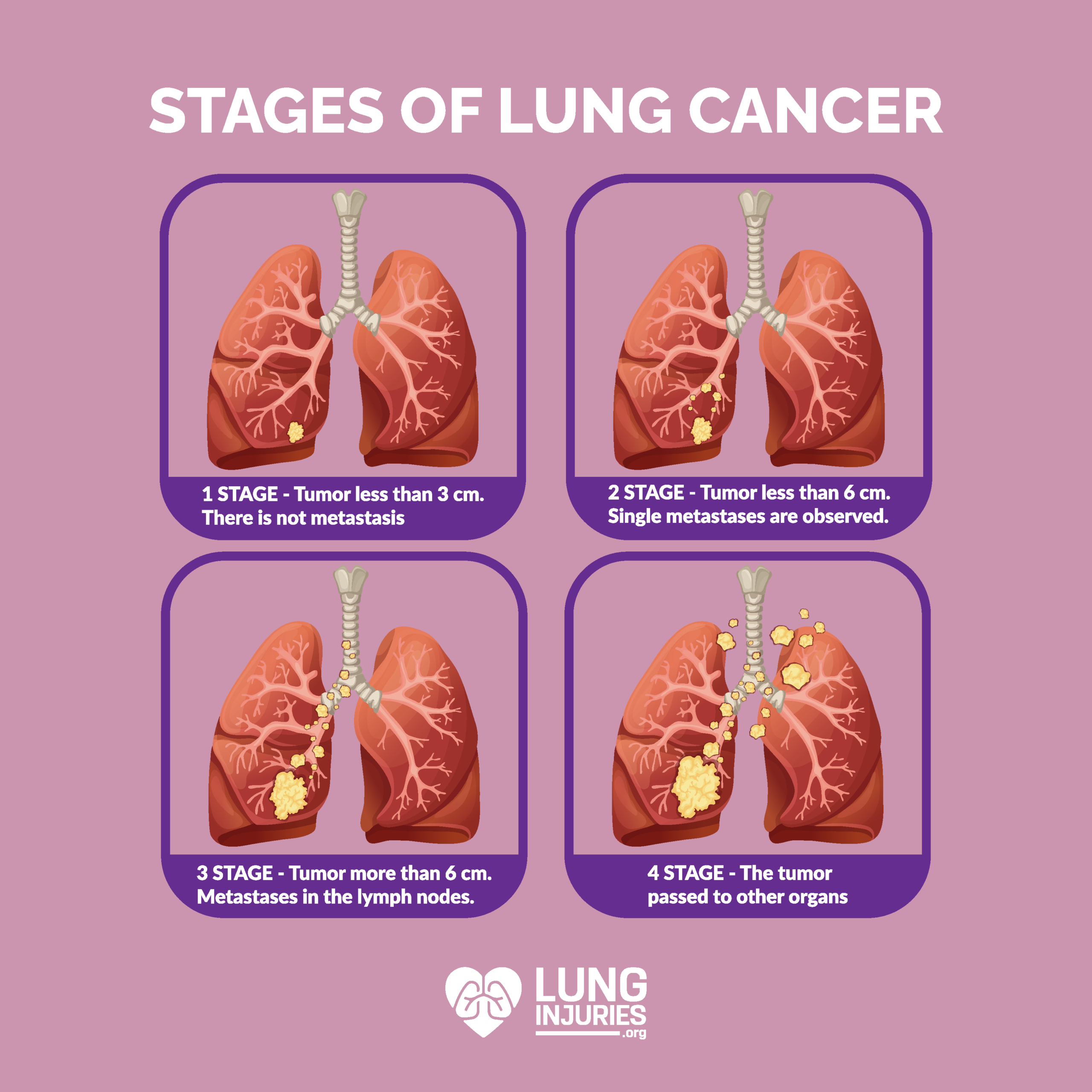 Stages Of Lung Cancer Chart